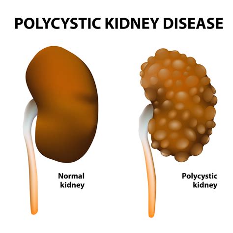 treatment for kidney disease: Can I Die of Polycystic Kidney Disease(PKD)?