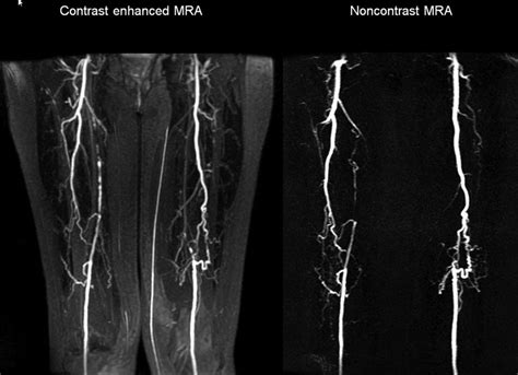 Approach to the Patient With Peripheral Arterial Disease | Circulation