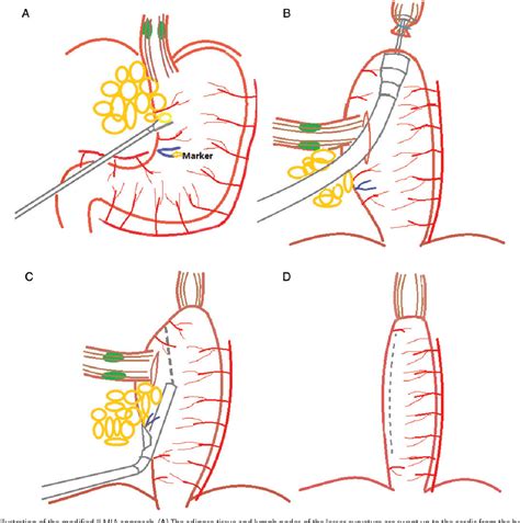 Figure 1 from Technical and early outcomes of Ivor Lewis minimally invasive oesophagectomy for ...