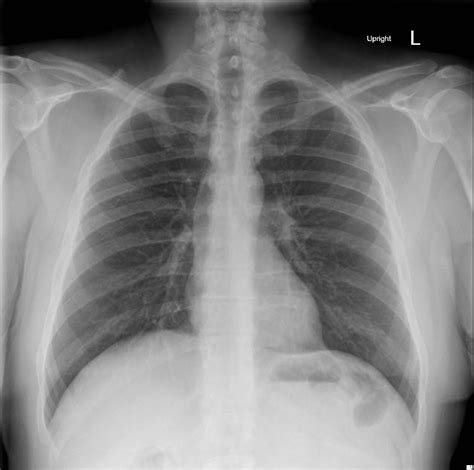 Normal chest xray - fiberbezy