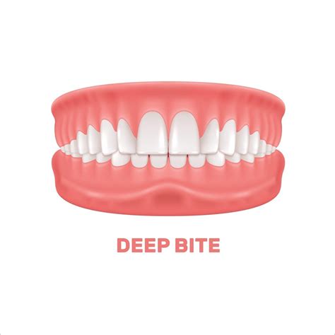 Deep Bite Treatment - Langley's Dental Centre