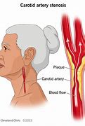 Image result for Carotid Artery Blockage Symptoms
