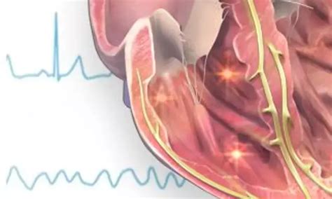 Ultra-short-acting B-blockers lower mortality in persistent tachycardia ...