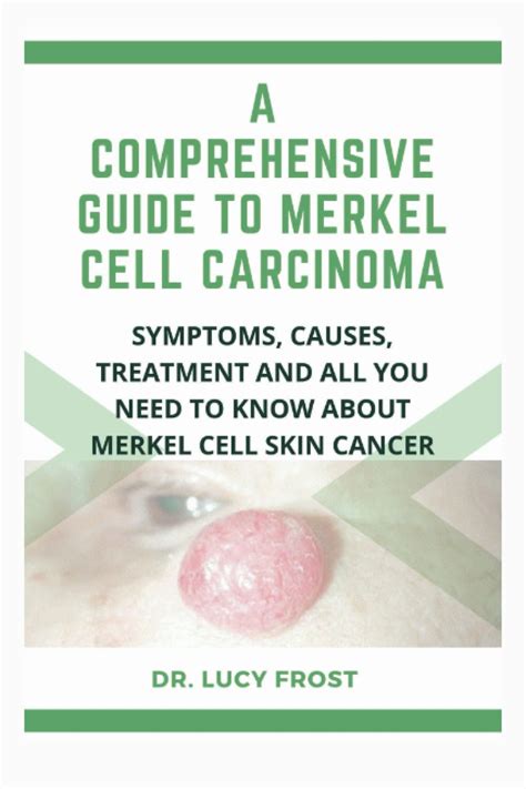Buy A Comprehensive Guide to Merkel Cell Carcinoma: Symptoms, Causes ...