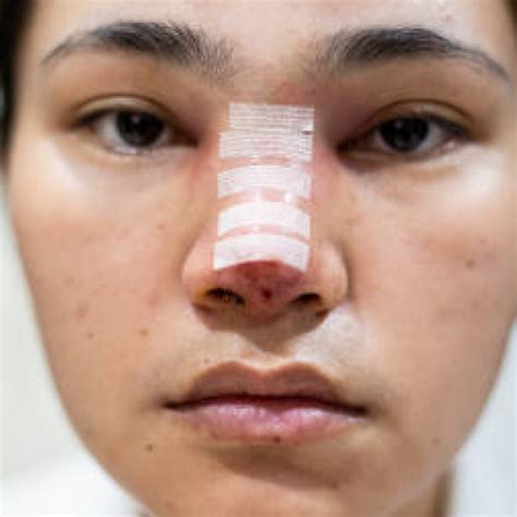 Functional Endoscopic Sinus Surgery (FESS)