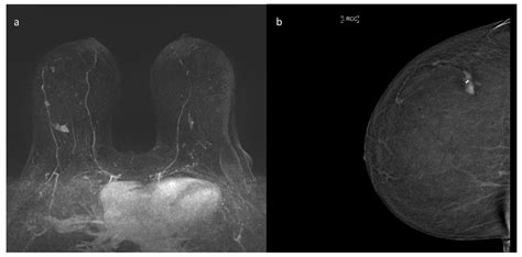 A Review of Breast Imaging for Timely Diagnosis of Disease