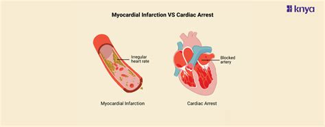 Difference Between Myocardial Infarction and Cardiac Arrest – Knya