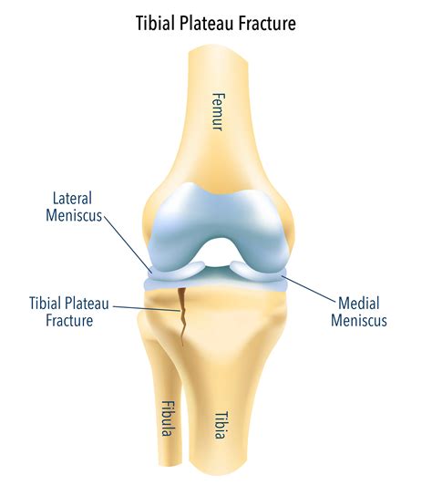 Tibial Plateau Fracture