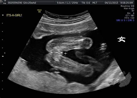 问医生这是18周B超图，怎么算胎儿大小，胎儿体重，是不是胎儿偏小，因月份较小，胎儿面部及胸腹腔细 - 百度宝宝知道