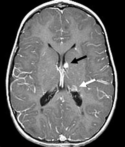 Tuberous Sclerosis Radiology