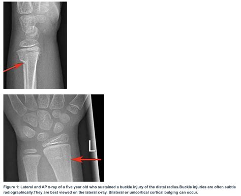 Buckle (Greenstick) Fracture of the Distal Radius - Sports Medicine Review