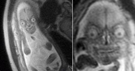 MRI Pictures Of Baby Evoke Horror