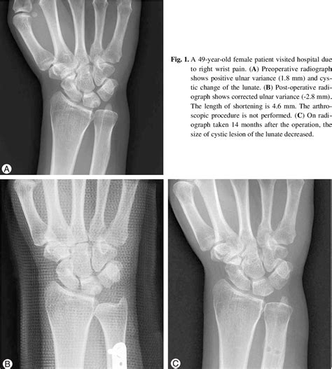 Figure 1 from Ulnar Shortening Osteotomy for the Treatment of Ulnar Impaction Syndrome ...
