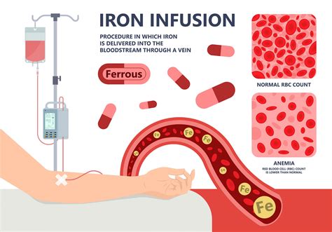 Iron Infusion - Infinity