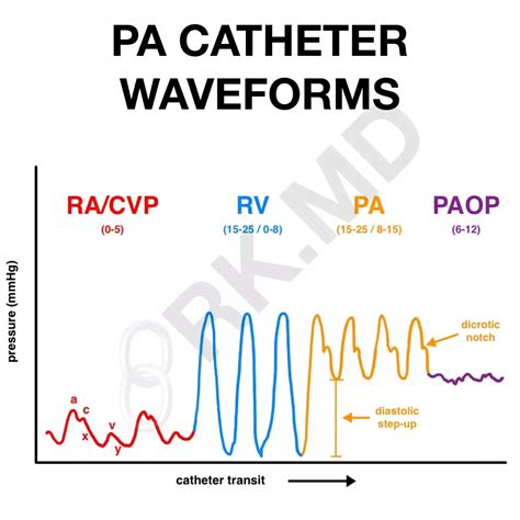 Pulmonary artery catheter swan ganz structure and waveforms – Artofit