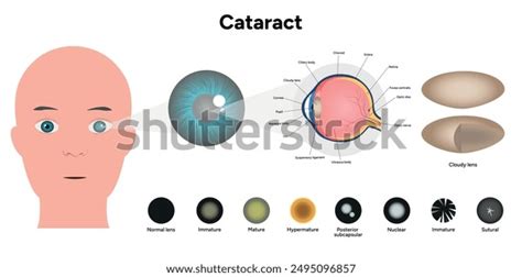 Vision Disorder 的图像结果