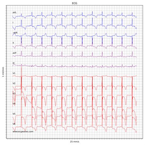 Dilated Cardiomyopathy Ecg