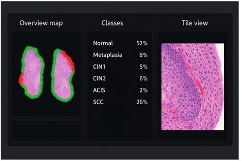 Digital Pathology with AI for Cervical Biopsies: Diagnostic Accuracy at ...