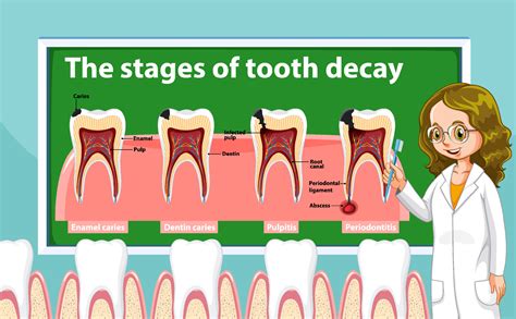 Tooth Decay Stages