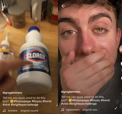 TikTok Challenge Goes Viral As Teens Press Bleach Packets On Their Eyes ...