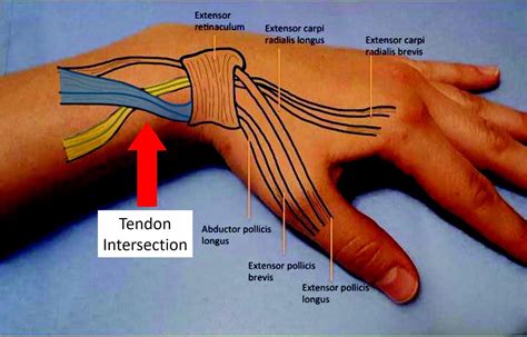 Wrist Tendonitis Pins And Needles at Isaac Oppen blog