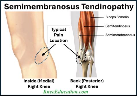 Hamstring Tendon Popping Behind Knee