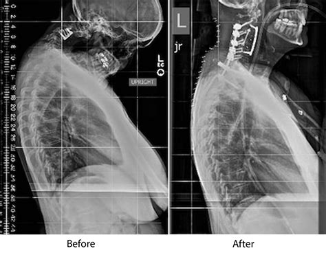 Dropped Head Syndrome