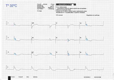 Evolution of Osborn’s J-wave in severe hypothermia | Medicina Intensiva