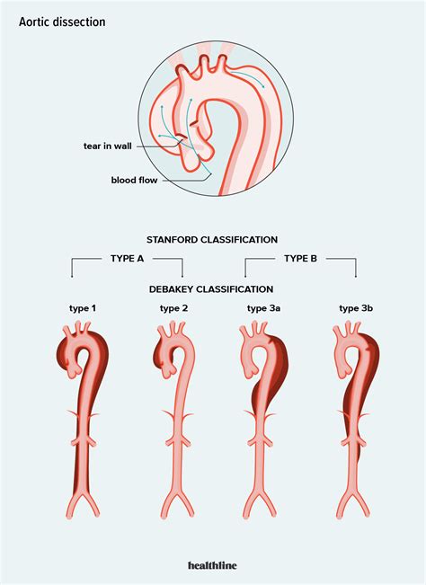 Aortic Dissection Type A | Dissection Aortique Signe Clinique – GAWPGS