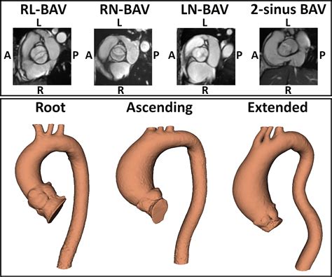 Mechanisms of Aortic Dilation in Patients With Bicuspid Aortic Valve ...