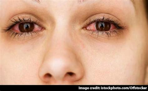 पीएम10 के संपर्क में आए तो दोगुना बढ़ सकता है आई इंफेक्शन का खतरा ...