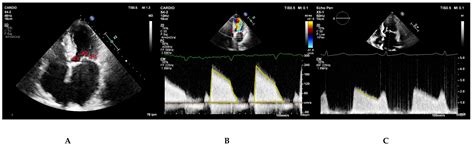 The Role of 2D and 3D Echo in Mitral Stenosis