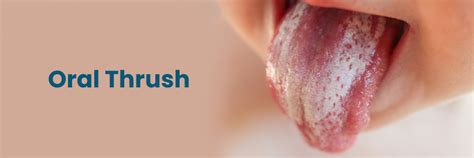 Síntomas de la candidiasis oral: cuándo buscar atención médica