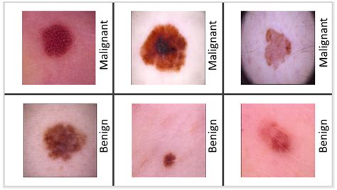 A Non-Invasive Interpretable Diagnosis of Melanoma Skin Cancer Using ...