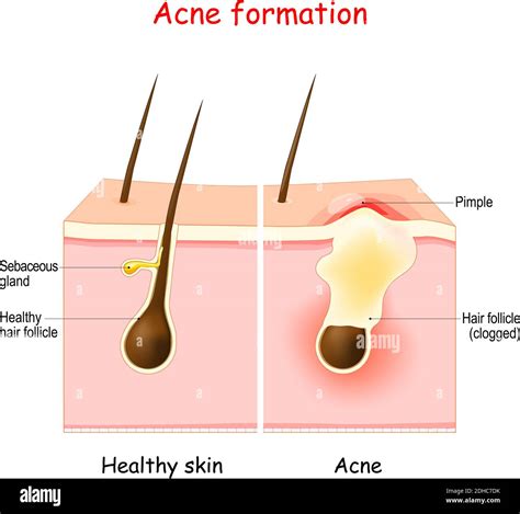 Sebaceous Gland Acne