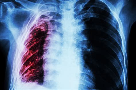 Atelectasis and Lung Cancer: What's the Connection?