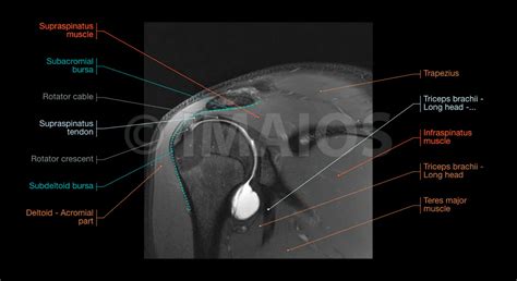 Mr Arthrogram Shoulder 的图像结果