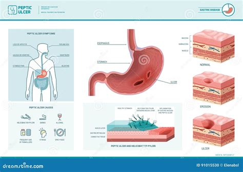Peptic Ulcer and Helicobacter Pylori Infographic Stock Vector - Illustration of diagram, gastric ...