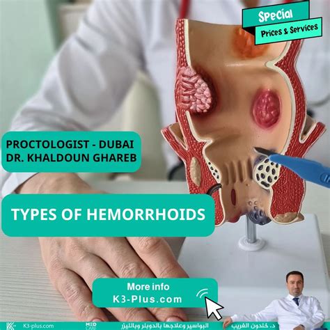 Thrombosed External Hemorrhoid Burst Haemorrhoids (Piles): Symptoms,