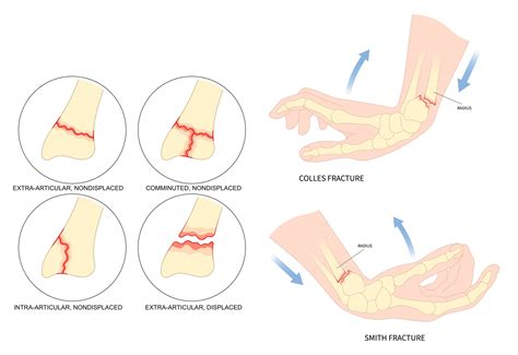 Distal radius fractures (broken wrist) | Explore Treatment Options ...