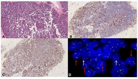 Diagnostics | Special Issue : Cell Block in Tumor Pathology, Molecular ...