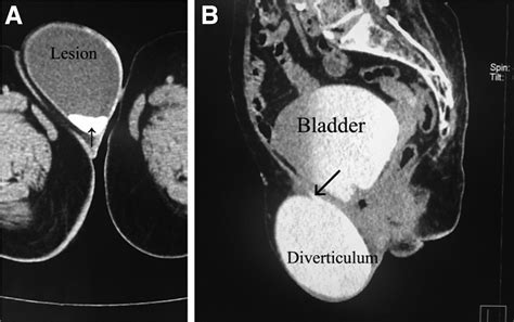 Labial swelling; anterior perineal herniation of urinary bladder diverticulum - American Journal ...