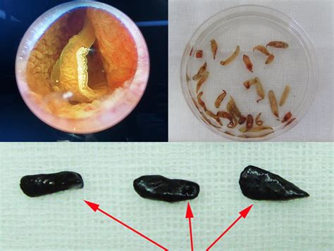 Human Liver Fluke