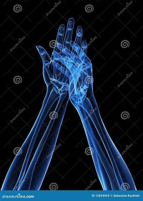 X-ray hands - arthritis stock illustration. Illustration of rheumatoid - 12694924