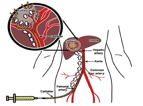 Uterine Fibroid Treatment in Noida | Varicose Veins Treatment in Noida ...