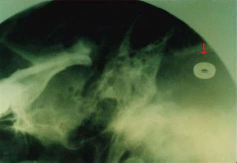 Image result for Alien Implants Just Schrapnel