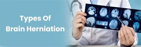 Tipos de hernia cerebral: una guía completa