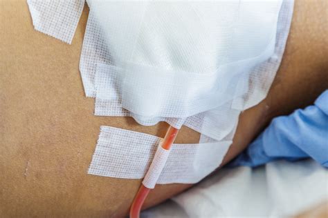 Robinson Drain Surgery - Best Drain Photos Primagem.Org