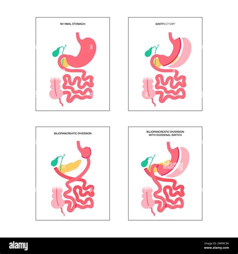 Types of bariatric surgery, illustration Stock Photo - Alamy