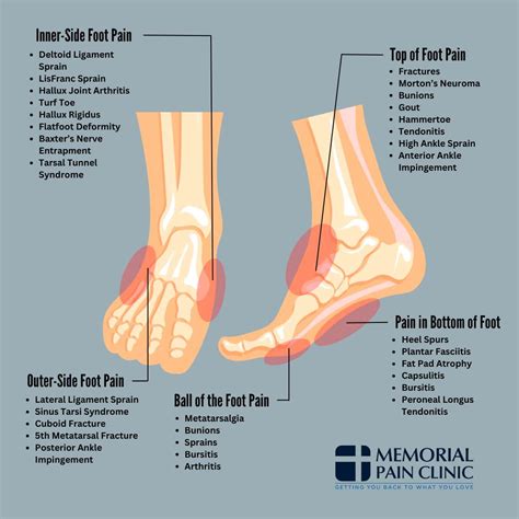 Foot Pain Chart: Common Foot Problems | Memorial Pain Clinic